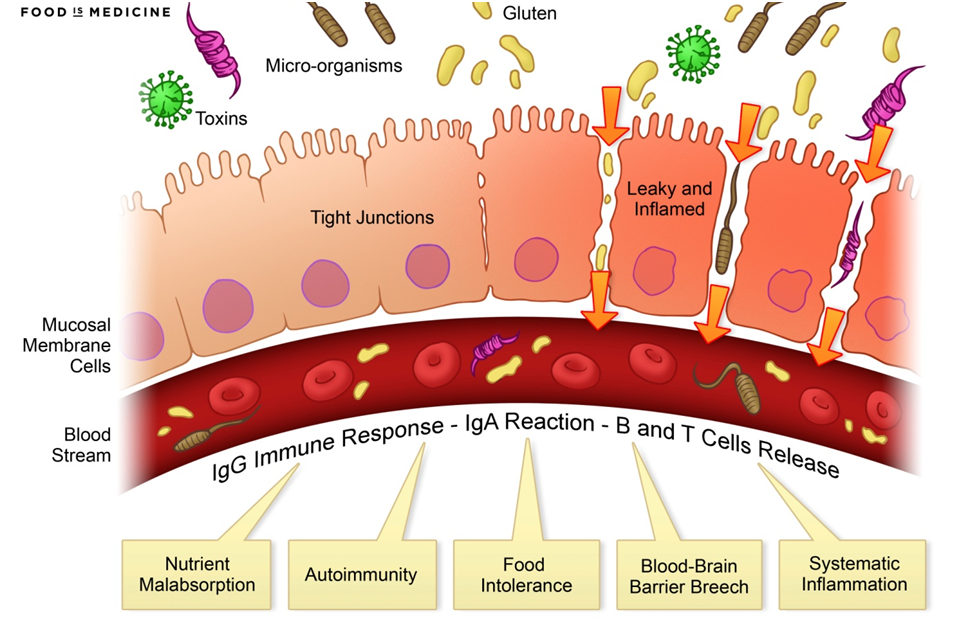 Leaky Gut and Endotoxemia: Are Bacterial Toxins Making You Sick?